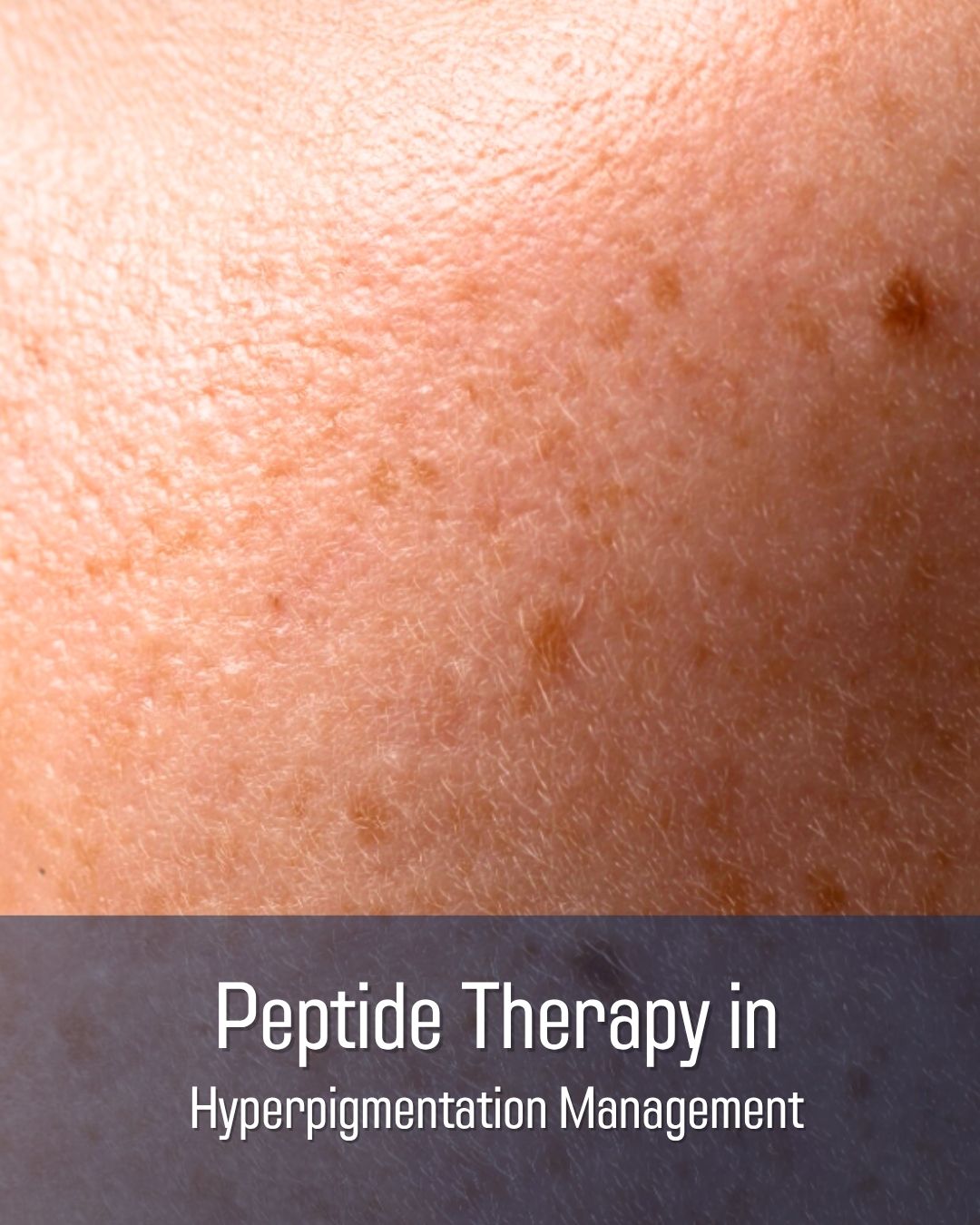 Peptide Therapy in Hyperpigmentation Management