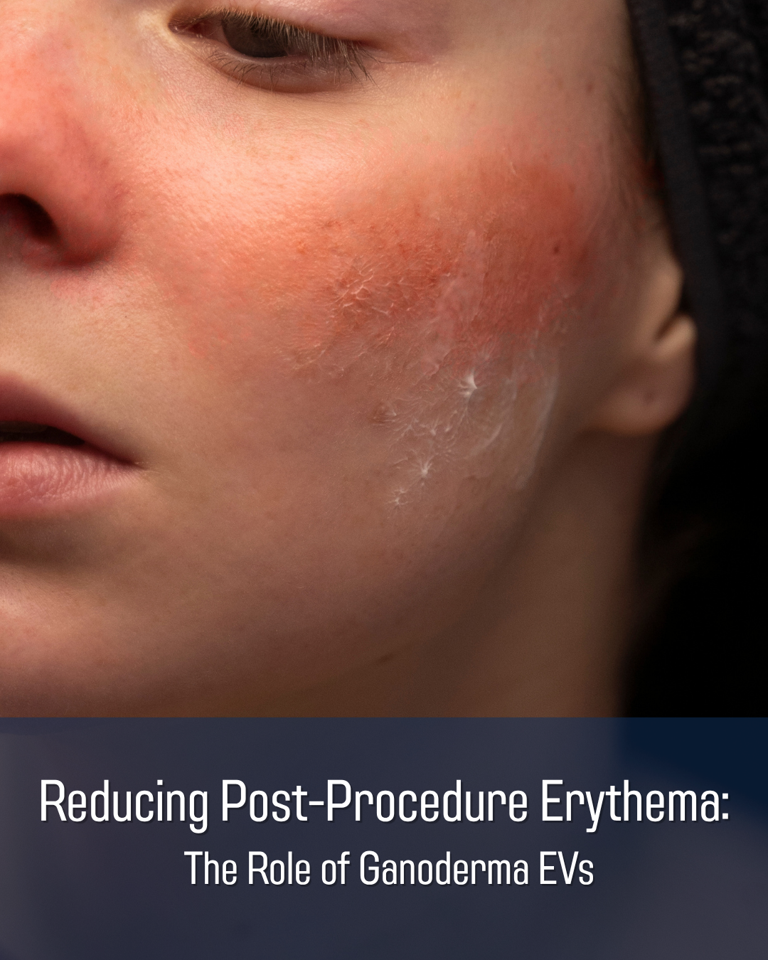 Reducing Post-Procedure Erythema: The Role of Ganoderma EVs