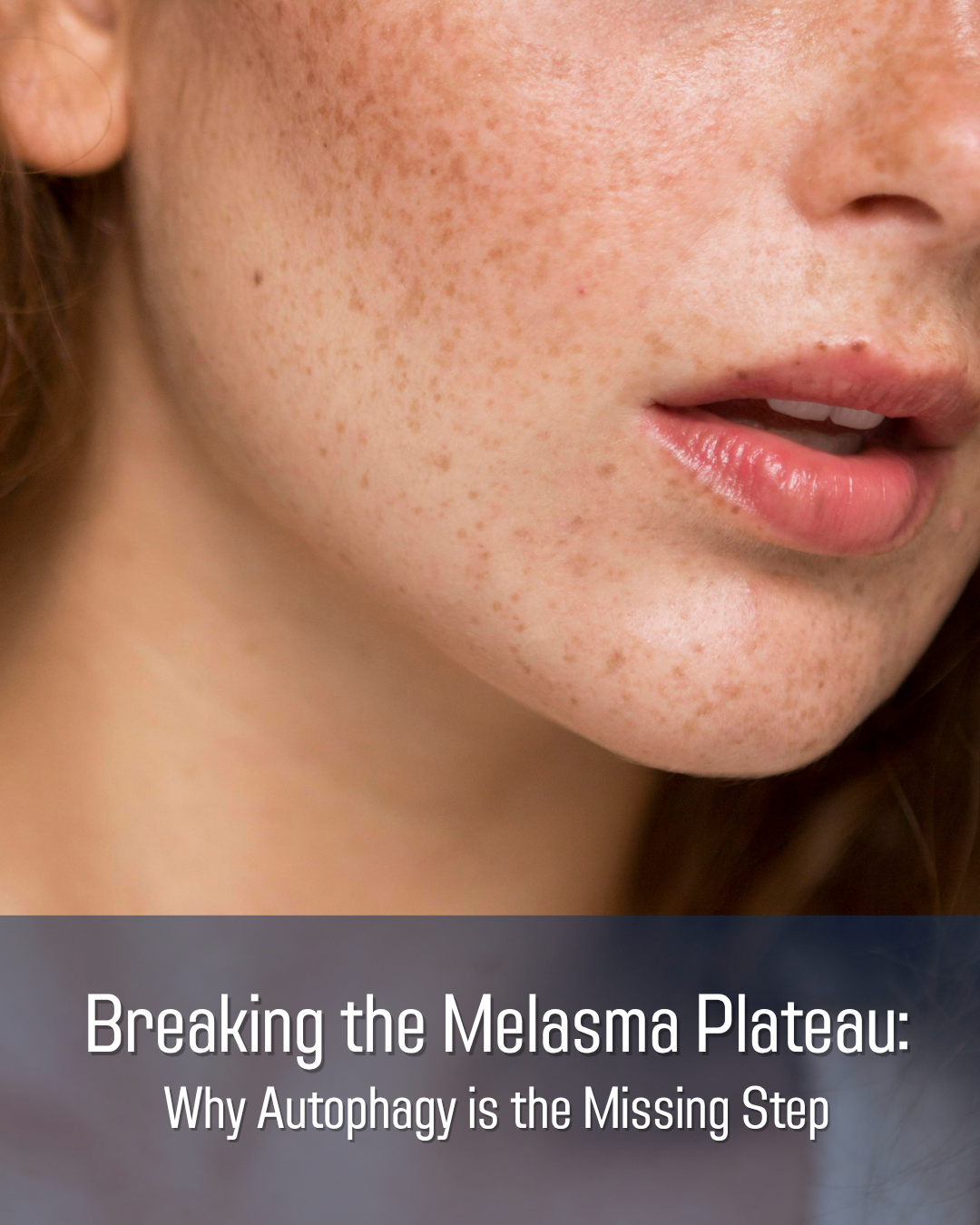Breaking the Melasma Plateau: Why Autophagy is the Missing Step